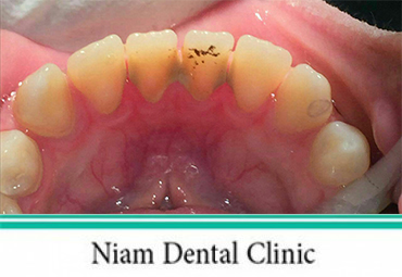 جرم گیری دندان