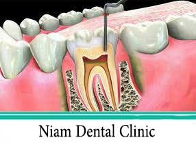 عصب کشی دندان