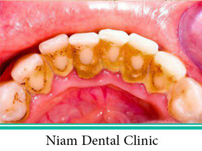 جرم گیری دندان