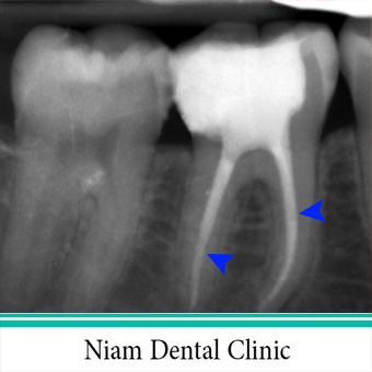 عصب کشی دندان
