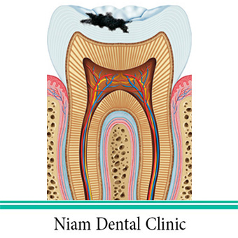 عصب کشی دندان