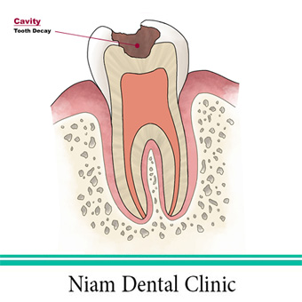 عصب کشی دندان