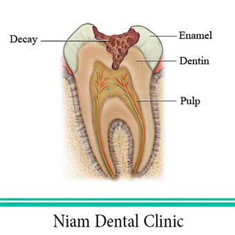 عصب کشی دندان
