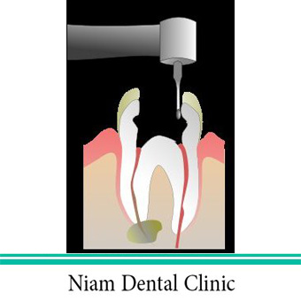 عصب کشی دندان