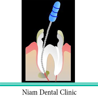 عصب کشی دندان