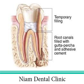 عصب کشی دندان