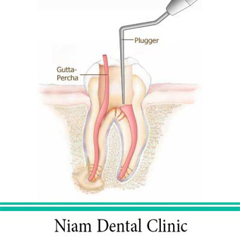 عصب کشی دندان
