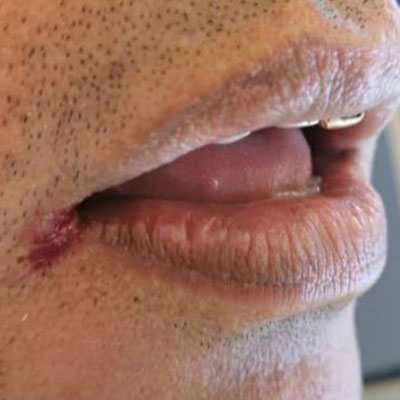 عفونت دهانی