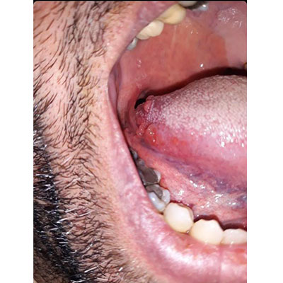 بیماری دهان