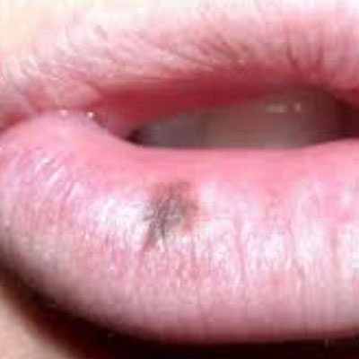 بیماری دهان