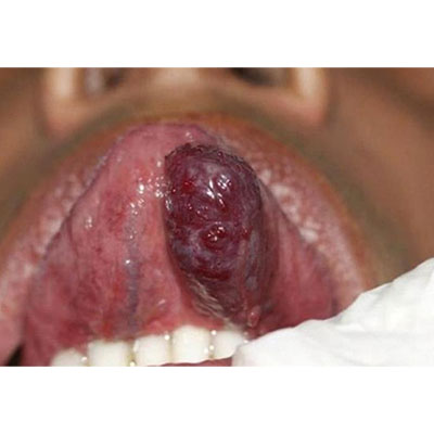 تومور خوش خیم دهانی