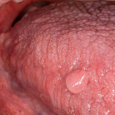 فیبروم دهانی