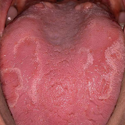 بیماری دهان